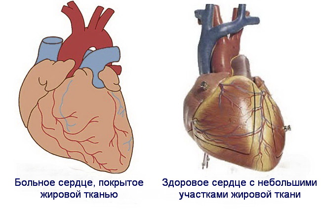 Как Влияет Лишний Вес На Сердце