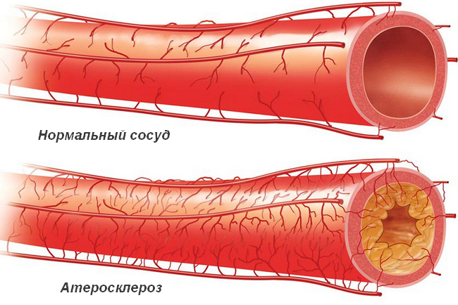Нормальный кровеносный сосуд и забитый атеросклеротической бляшкой