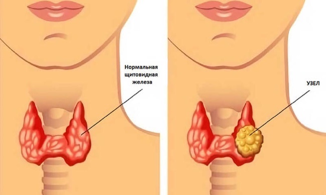 Снижение веса при щитовидной железе симптомы и лечение